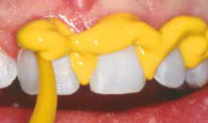 Нанесение Хонигум Лайт - этап 1